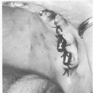 2 Double posted blade used in long edentulous span for ample support