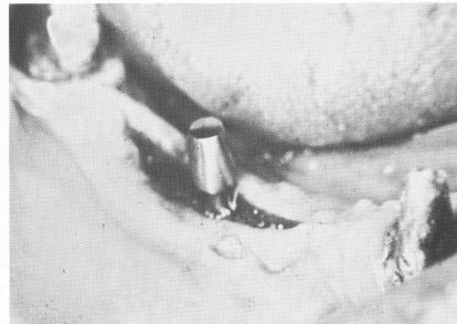 3 Even spacing between both natural and implant abutments in maxilla