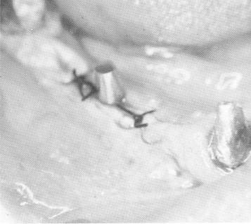 4 Mandibular blade implant centered between natural abutments