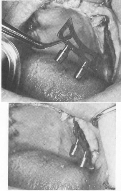 5 Mandibular site closed with simple sutures after blade insertion