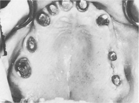 1 Upper and lower dental restorations cemented in place