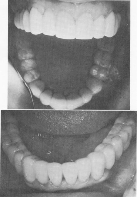 2 Anterior,left,& right lateral views of upper & lower arch restorations