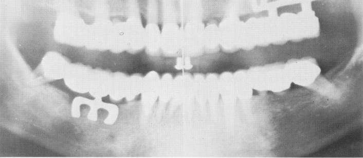 1 Edentulous span between maxillary cuspid and second molar