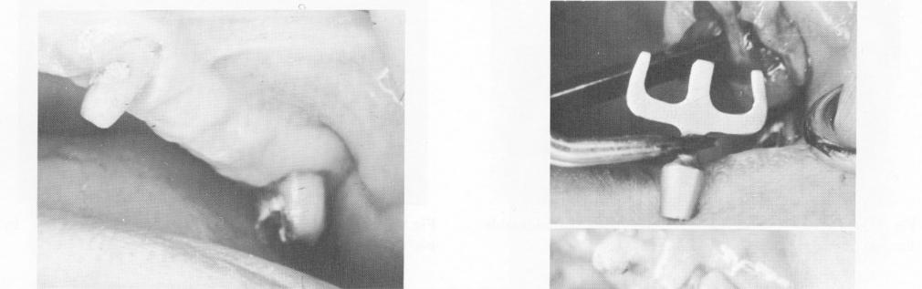 2 Blade seated in edentulous span between upper cuspid & second molar