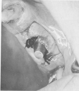 1 Vertical incisions avoided during dental blade insertion