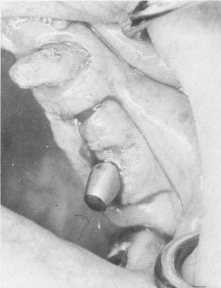 2 Sutures closely adapted to post of maxillary bladevent