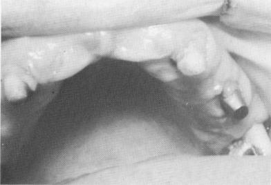 3 Maxillary implant site after five days of bladevent insertion