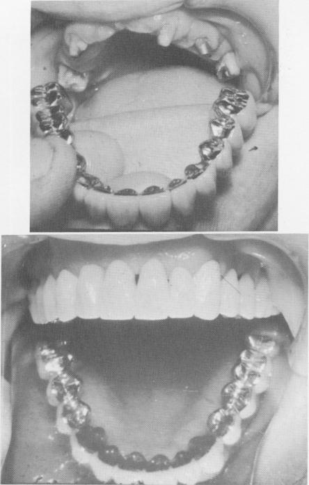 4 Full arch acrylic and gold prosthesis cemented over blade implants