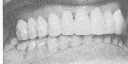 1 Open ended blade implant used for unusually dense maxilla