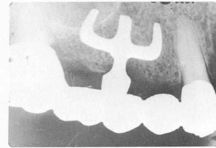 2 Periodontally involved teeth view that supported removable appliance
