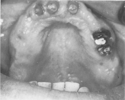 1 Maxillary teeth prepared after periodontal therapy