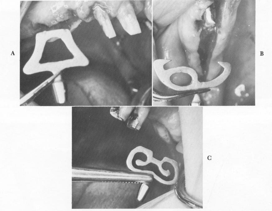 2 Bicuspid blade implant placed into groove in upper jaw