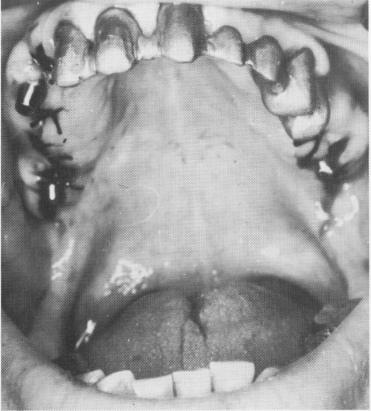 1 Soldered gold copings on maxillary pontics fitted over prepared teeth