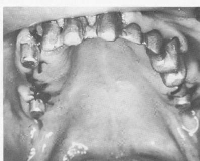 2 Aluminum shells trimmed & placed over maxillary blade implant posts