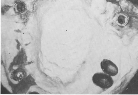 3 Plaster index of maxillary arch