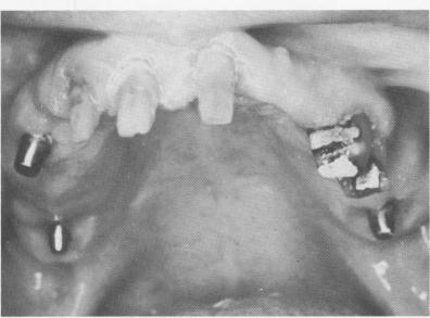 4 Full arch porcelain fused to metal prosthesis over maxillary blades