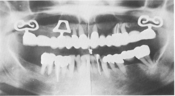 1 Panorex of completed maxillary restoration over bladevents