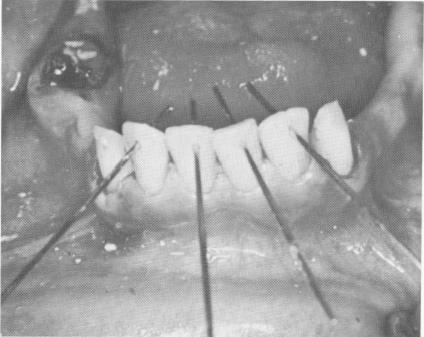 1 Nonparallel pins inserted labially above mandibular teeth pulp horns