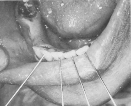 2 Pins adjusted to fit flush with lingual aspects of anterior teeth