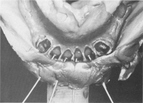 3 Pins reinserted in rubber impression after it is removed from mouth