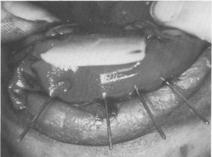 4 Lingual casting & veneer crown restorations fitted & articulated