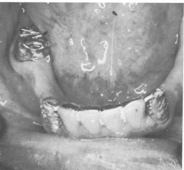 5 Finished mandibular prosthesis with plastic headed screws in position
