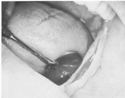1 Long shallow blade implant used because of lack of mandibular bone