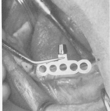 2 Finished mandibular prosthesis with color coded screws inserted
