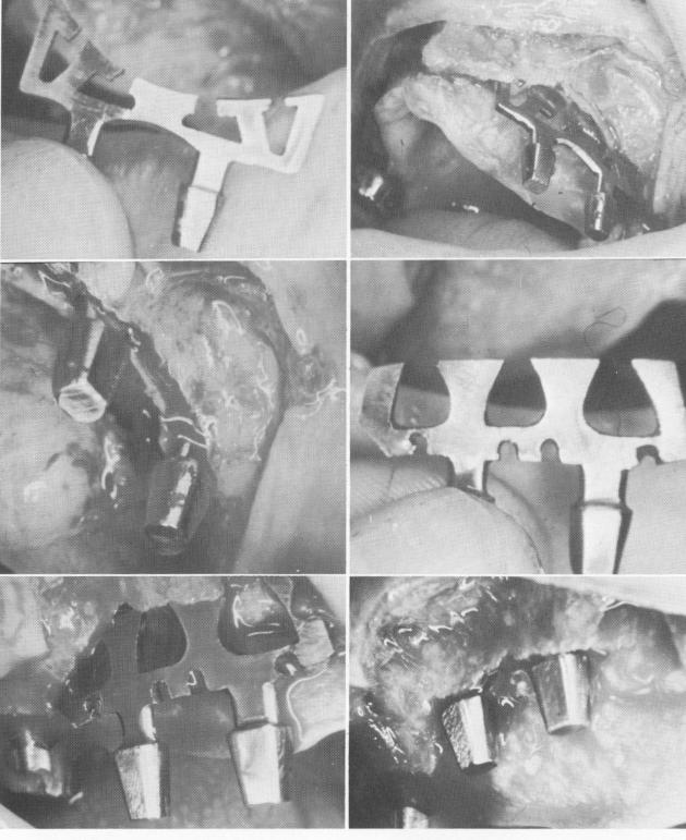 1 Double posted implant, bent to conform to groove of maxillary ridge