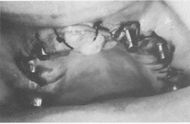 1 Maxillary soft tissue inflammation by ill fitting temporary splint