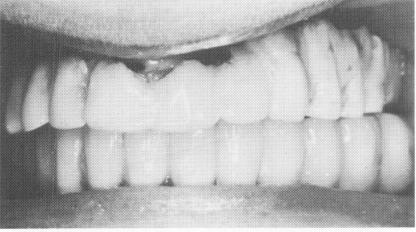 2 Copings fitted over maxillary implants