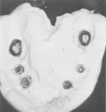 3 Maxillary plaster index with copings included