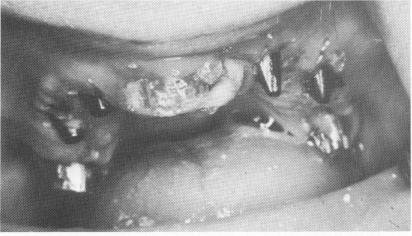4 One piece metal casting fitted over maxillary abutments