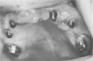 1 Biscuit baked maxillary prosthesis tried.Occlusal,esthetic changes done