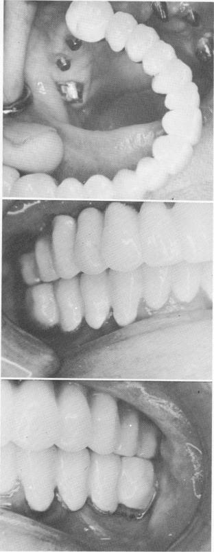 2 Final maxillary prosthesis cemented in place