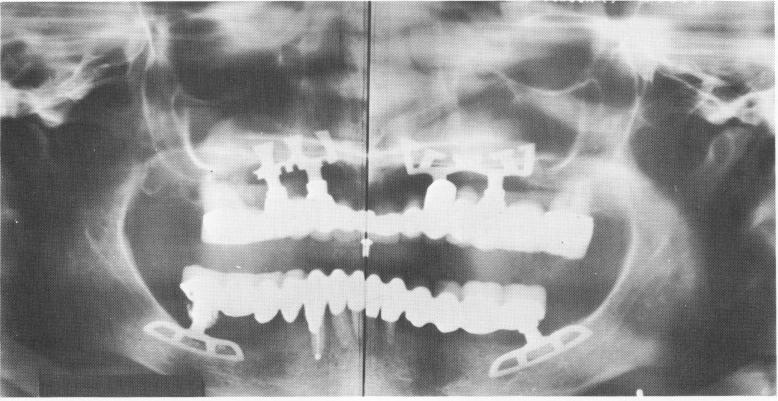 1 Maxillary restoration with two blades, each covering four teeth span