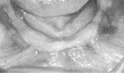 2 Picture showing edentulous mandible