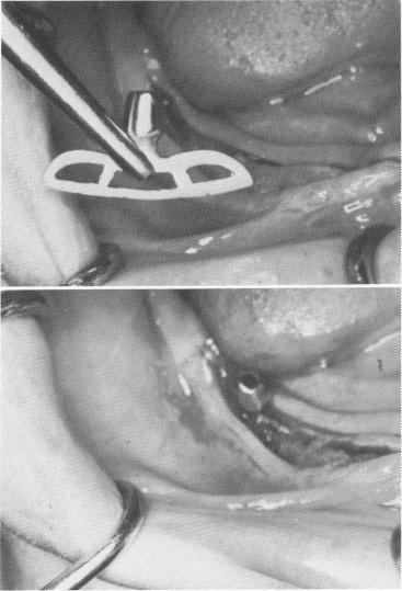 1 Narrow blade used in jaw with not enough bone above mandibular canal