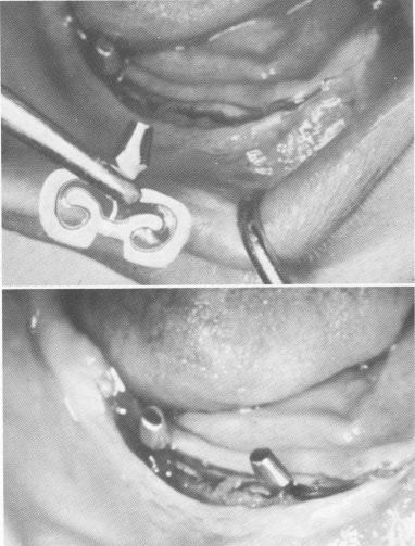 2 Blade longer in superior & inferior dimensions used in mandible