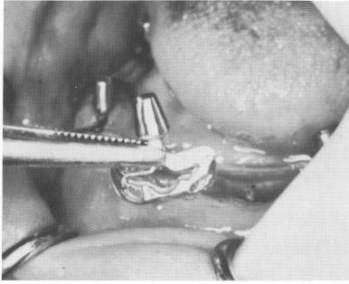 3 Four smaller single headed blades used in mandible with lesser room 