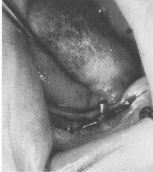 4 Curved blade following contour of bone in lower left cuspid region