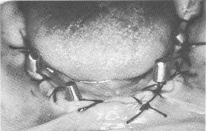 1 Mandibular old denture relined with soft tissue conditioner