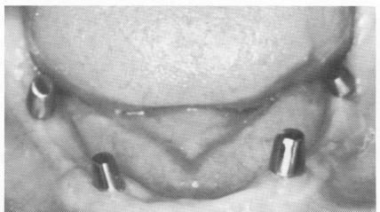 2 Excellent healing around mandibular implant posts postoperatively