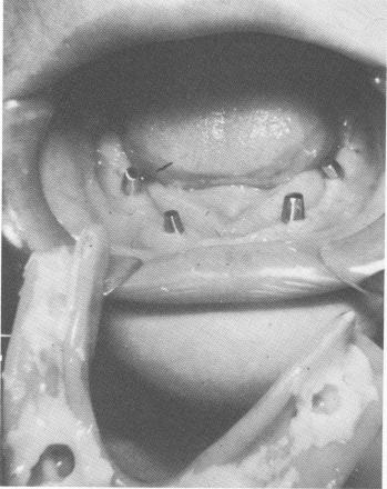 3 Acrylic over gold full arch fixed denture with six gold occlusal stops