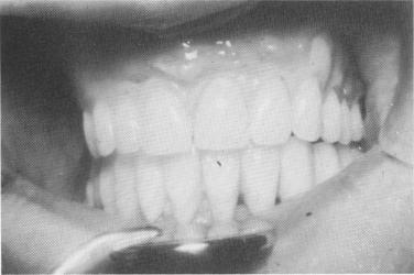 1 Final maxillary prosthesis in place with open anterior flange