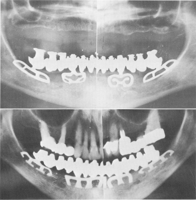 2 Full denture in edentulous mandible opposite natural upper dentition