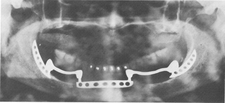 1 Retromolar blade implant abutments & anterior blade in mandibular arch