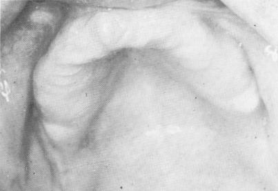 1 Edentulous maxilla with fibromucosa camouflaging the underlying bone