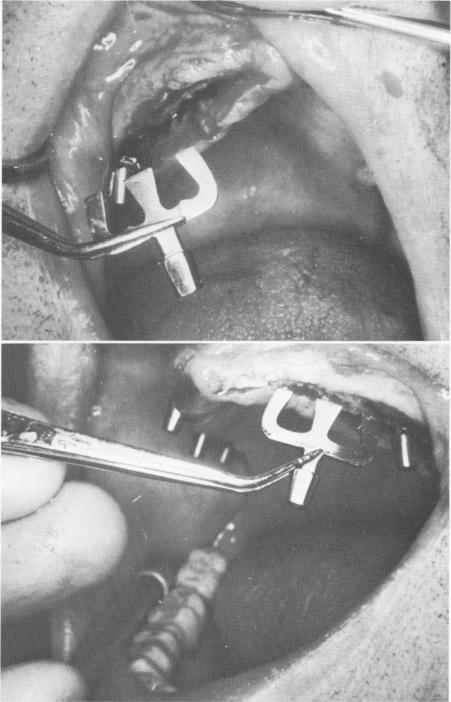 2 Palateless denture with deep channel to accept protruding implant post