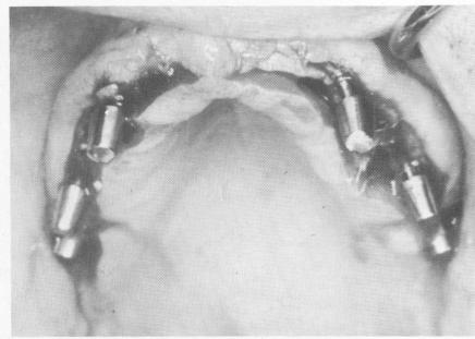3 Implants tapped into grooves made in maxillary knife edge ridge